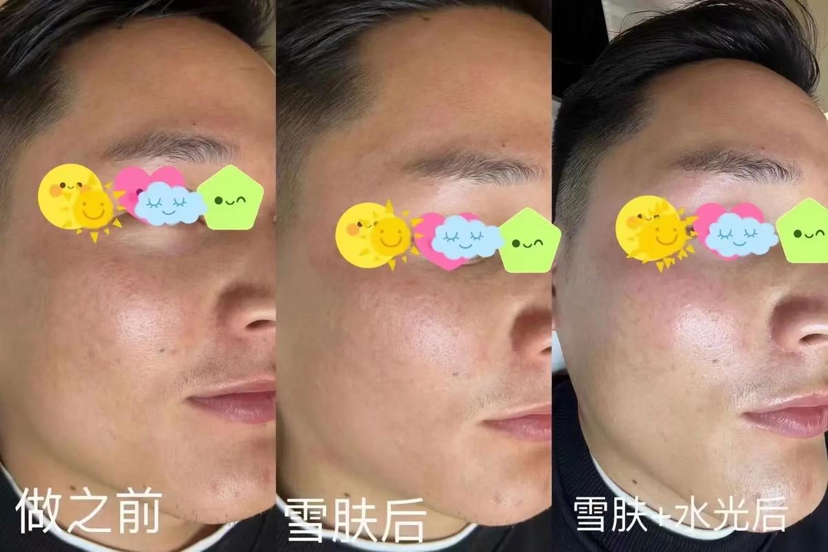 镭射净肤是什么