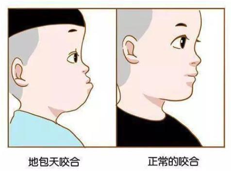 什么是兜齿