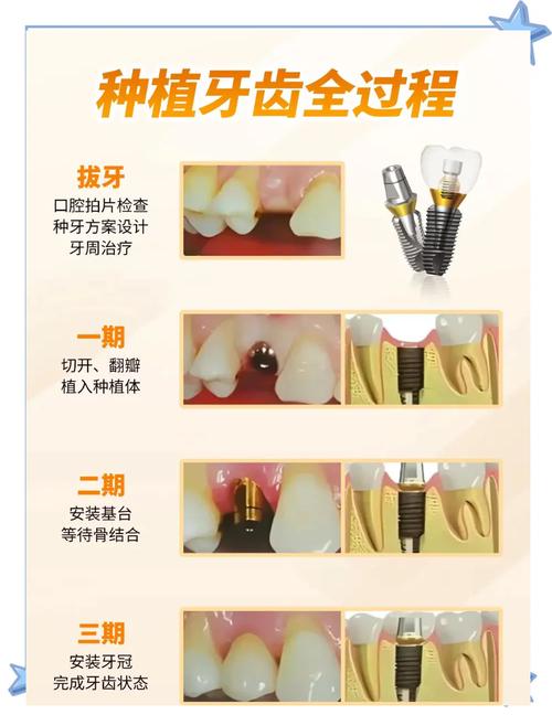 牙齿种植是什么意思