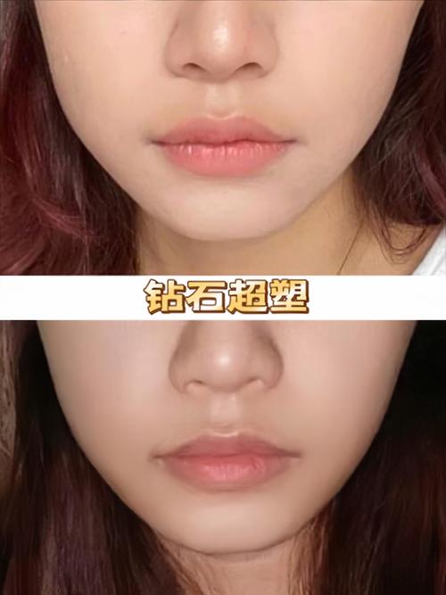 为什么减肥咬肌酸疼