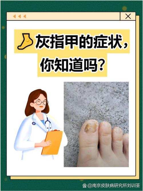 灰指甲会导致什么