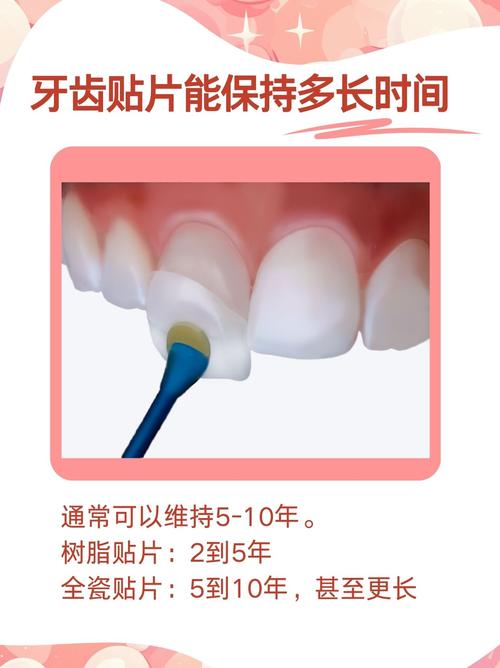 牙齿贴片什么意思