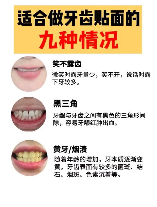 牙齿贴片什么意思