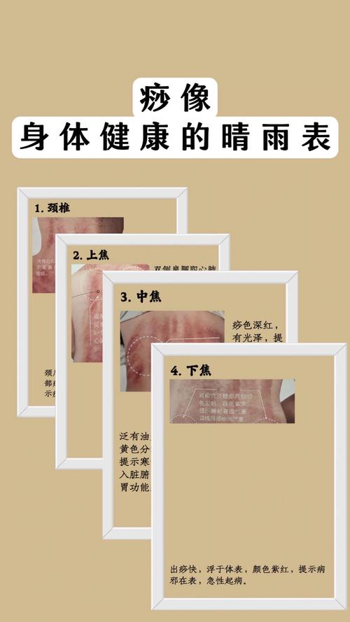 背部刮痧有什么好处