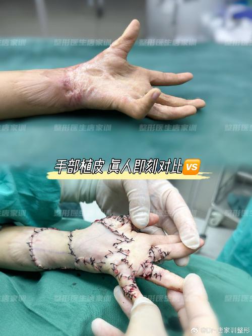 什么是植皮手术