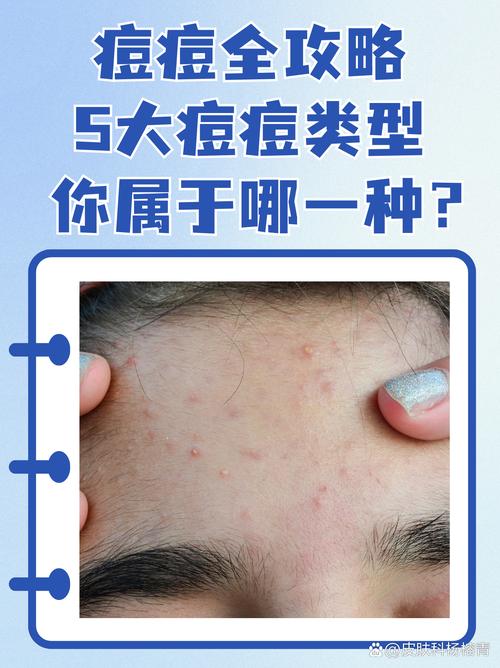 什么是座疮