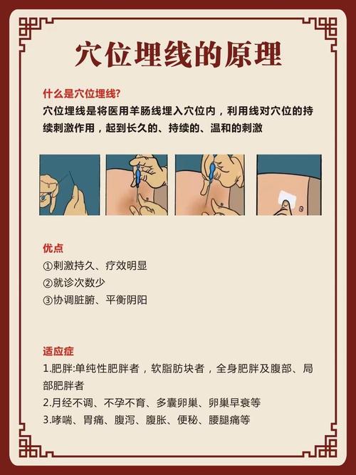 什么事埋线减肥