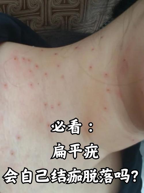 为什么会长扁平疣呢