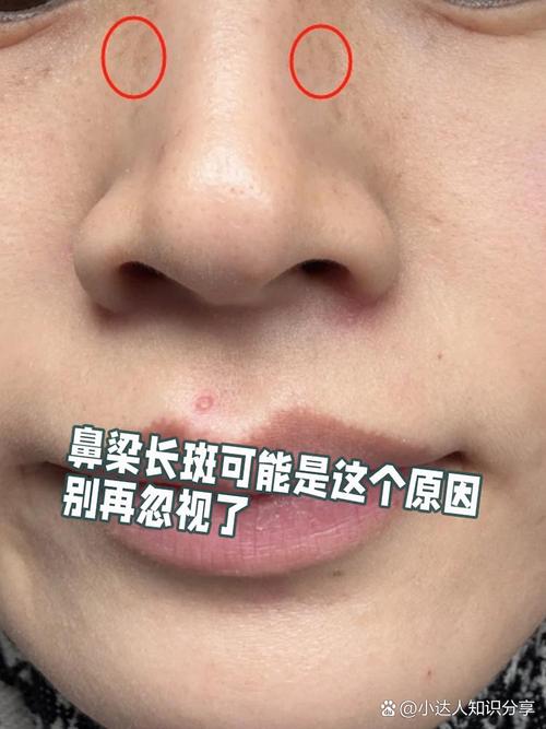 鼻梁长斑是什么原因