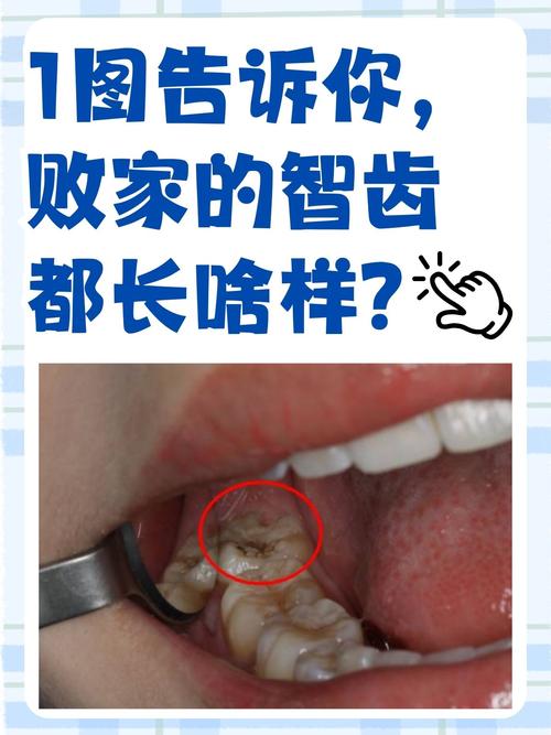 智齿为什么长不出来
