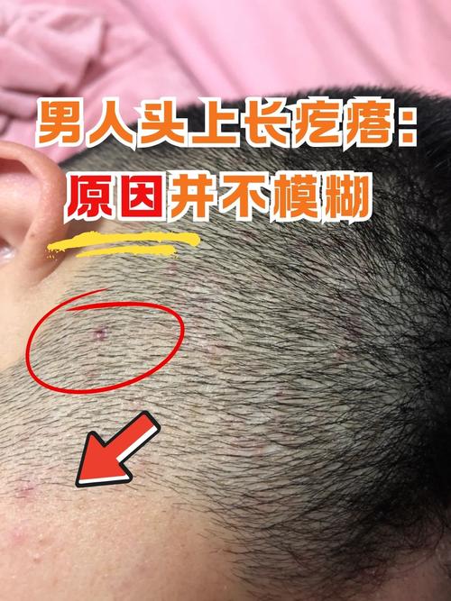 头皮为什么会长痘痘