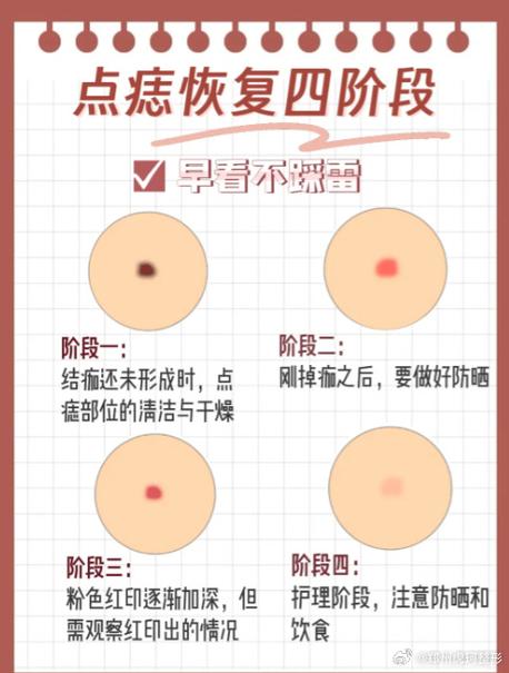 点痣什么时候好