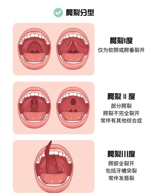唇腭裂是什么原因