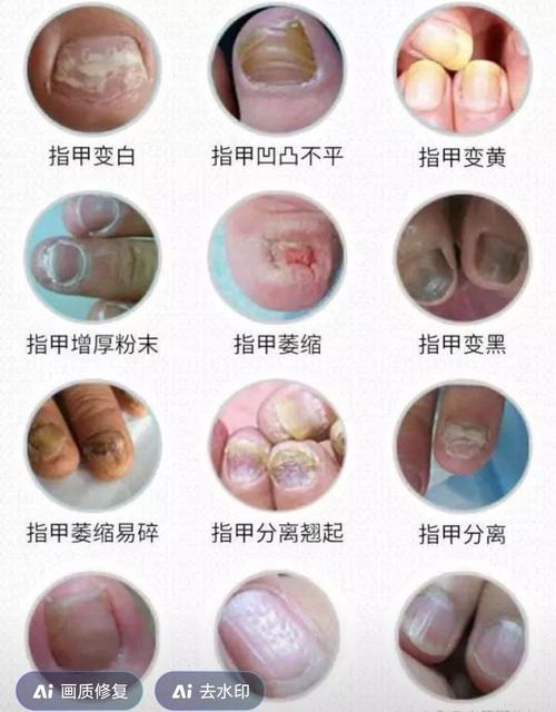指甲变色是什么原因
