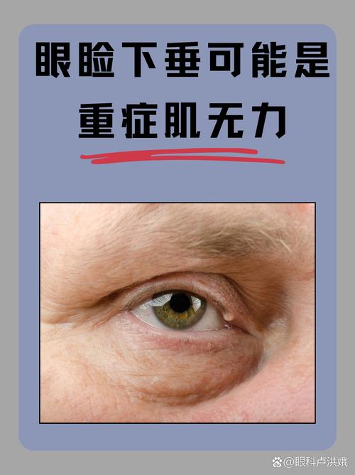 眼皮耷拉是什么病