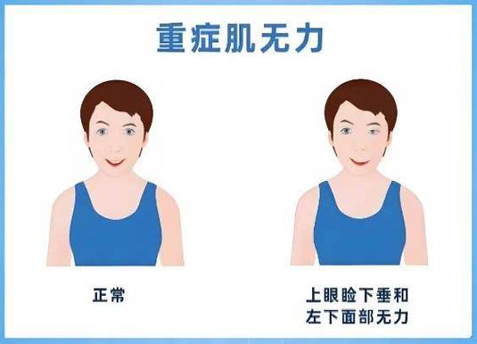 眼皮耷拉是什么病