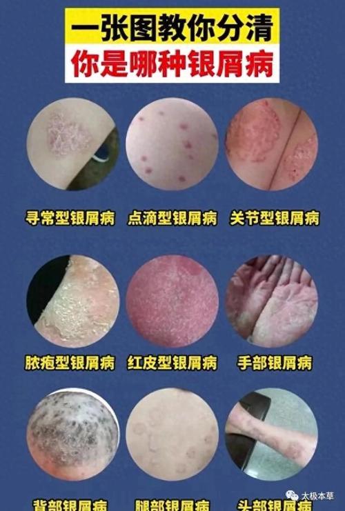 银血病是什么