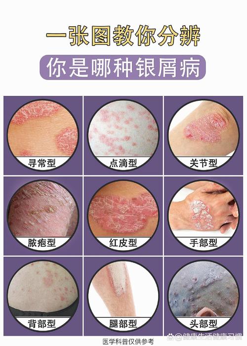 银血病是什么