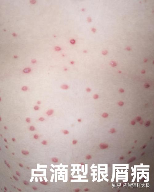 银血病是什么