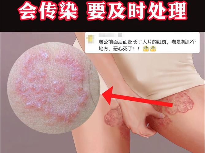 什么叫股癣