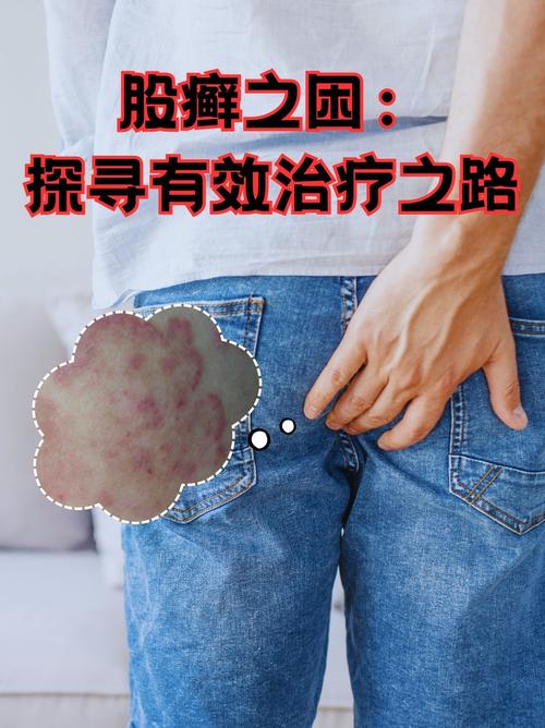什么叫股癣