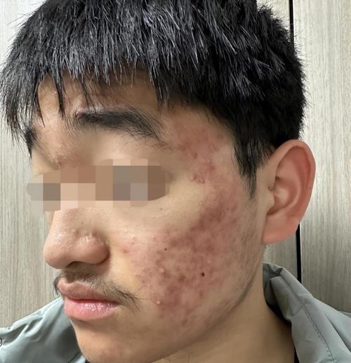 青春痘是什么样子的