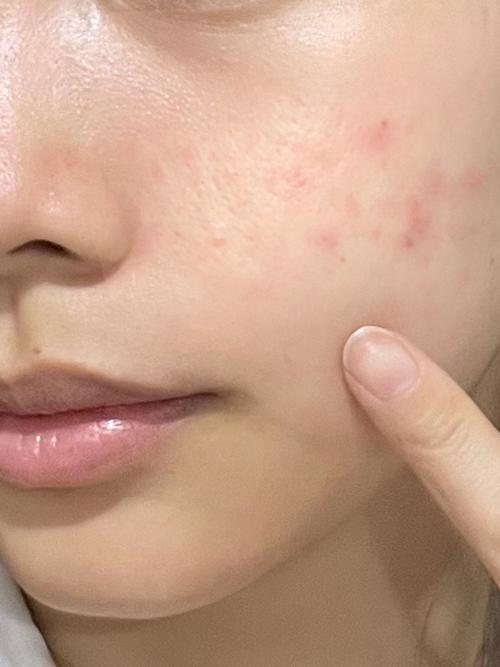 青春痘是什么样子的