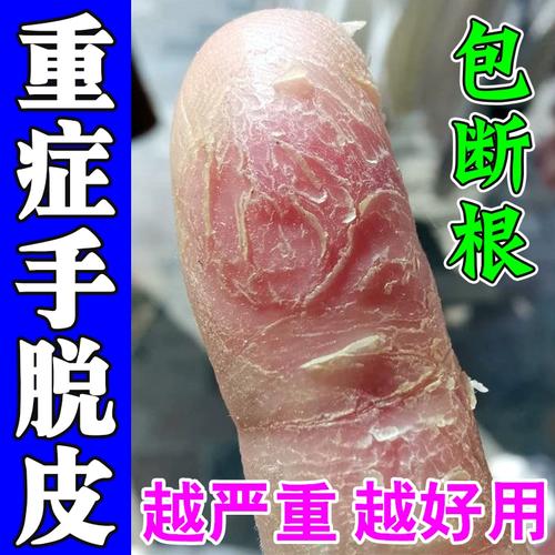冬天手脱皮用什么药