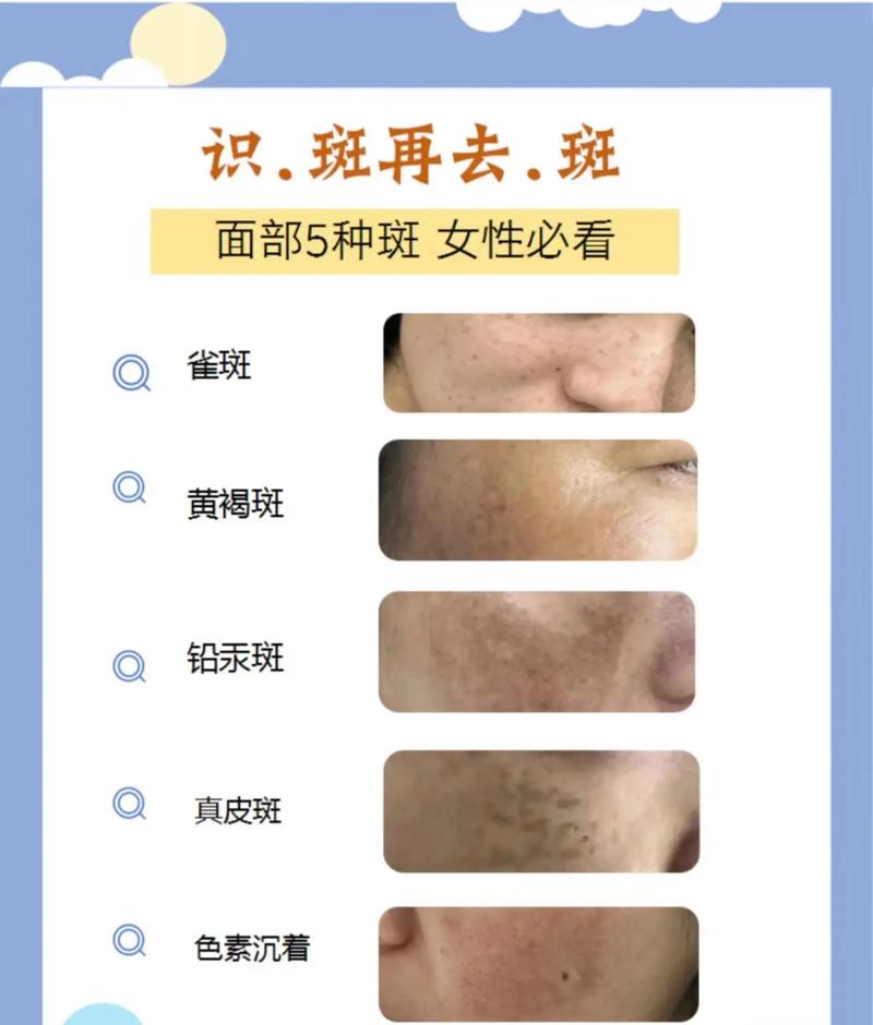 为什么脸上会长斑点