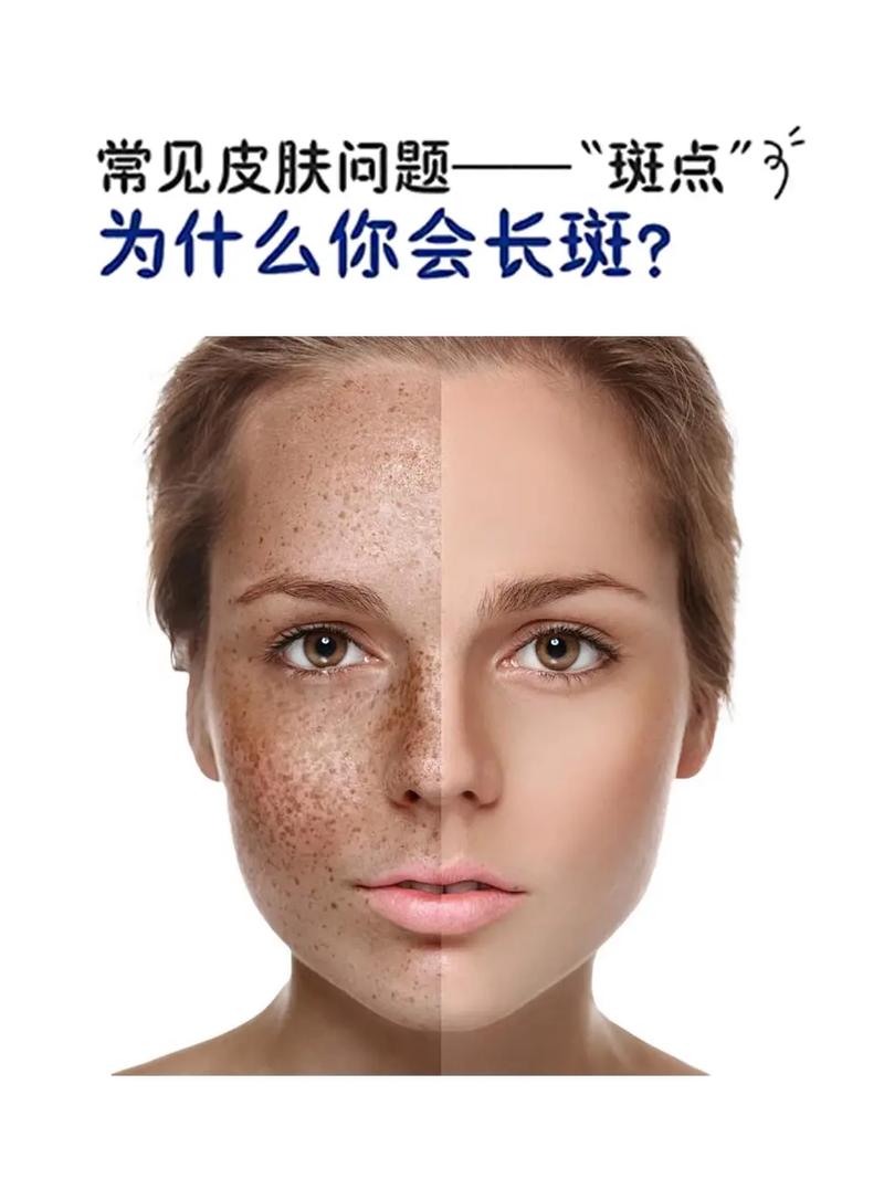 为什么脸上会长斑点