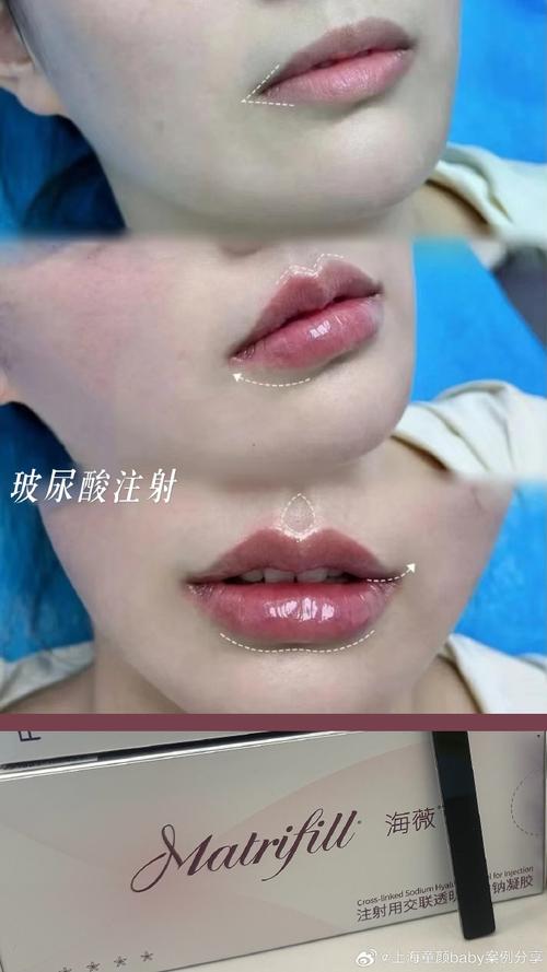 丰唇用什么玻尿酸