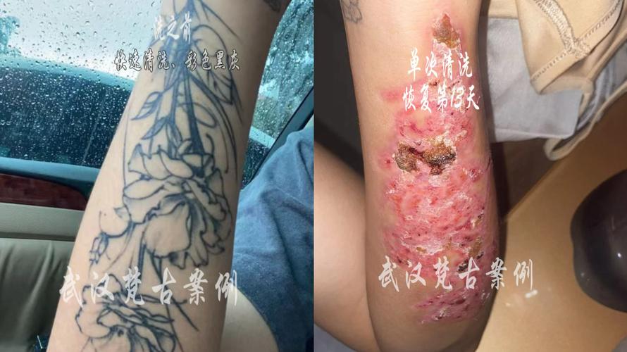 什么医院可以洗纹身