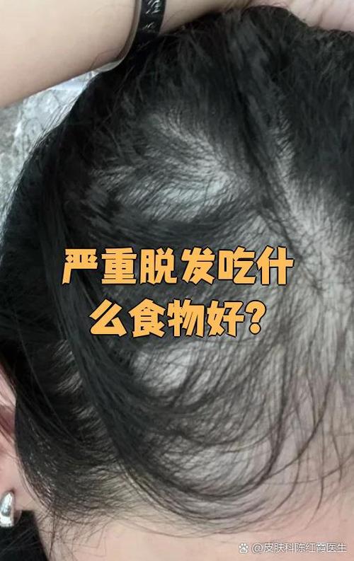 头顶脱发吃什么好