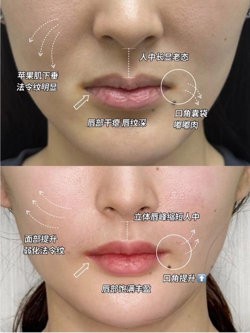 什么是鼻沟唇