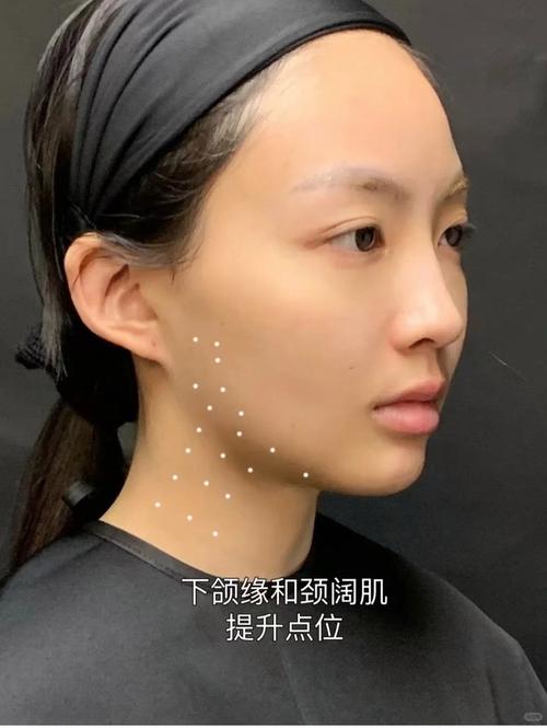 下颌缘提升是什么