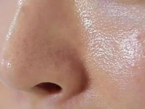 脸上出油是什么皮肤