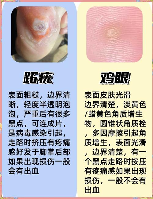 鸡眼看什么科室