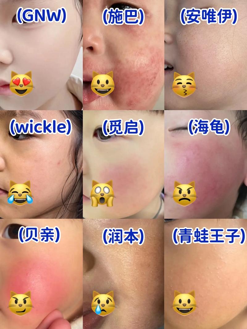 小孩洗洗面奶会长痘痘怎么回事
