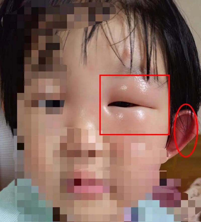 眼睛肿什么病