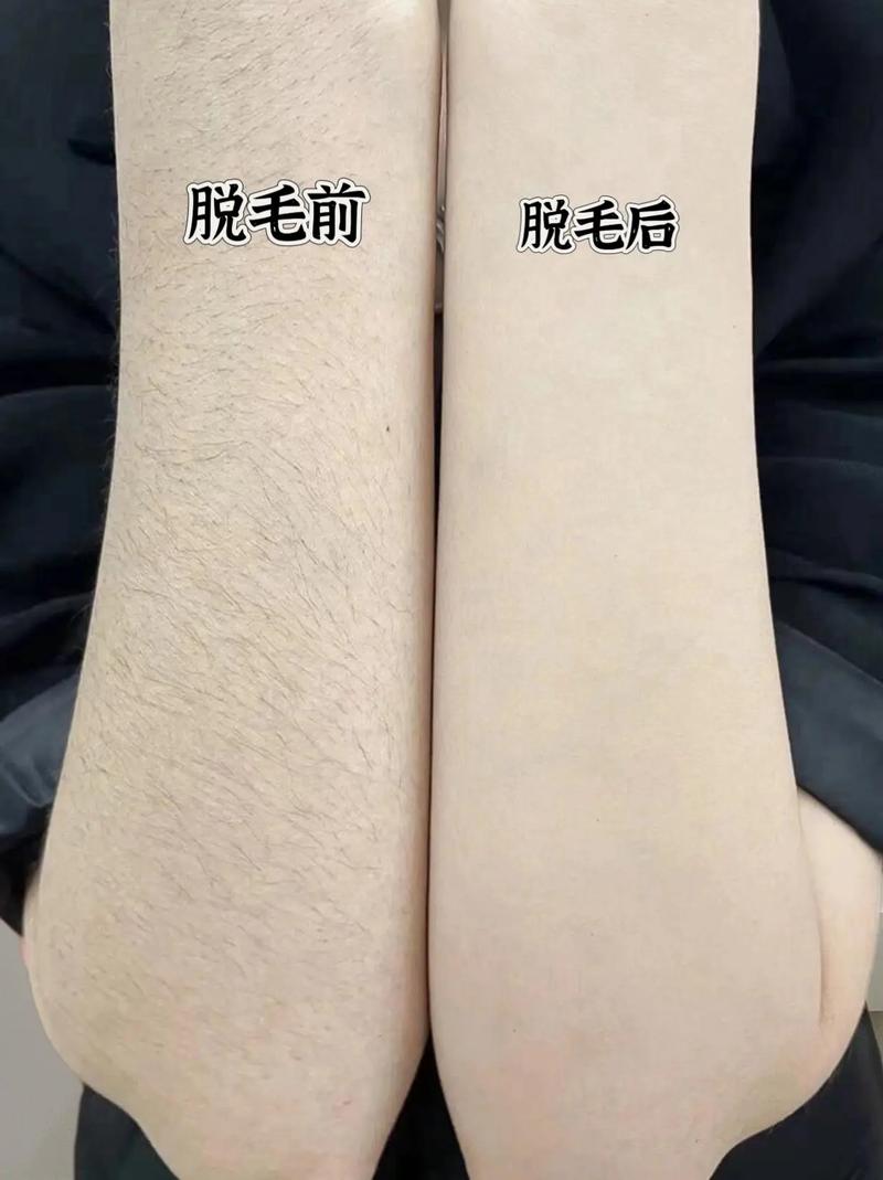 有什么可以脱毛