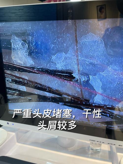 头发的毛囊是什么样的
