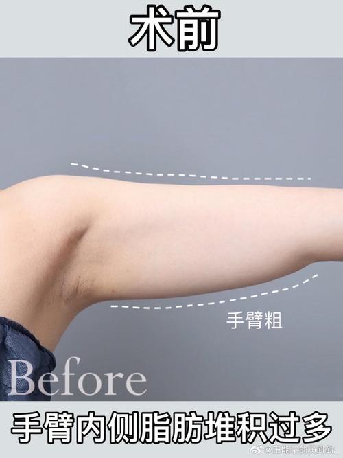 手臂为什么越来越粗