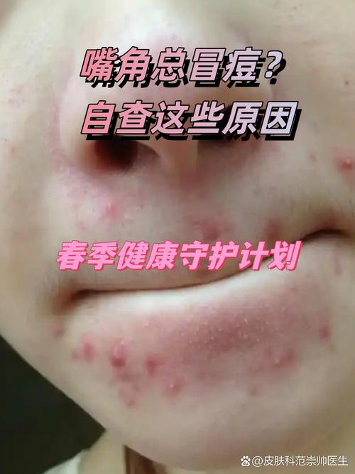 嘴边起痘痘什么原因