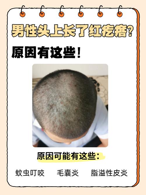为什么头上会长疙瘩