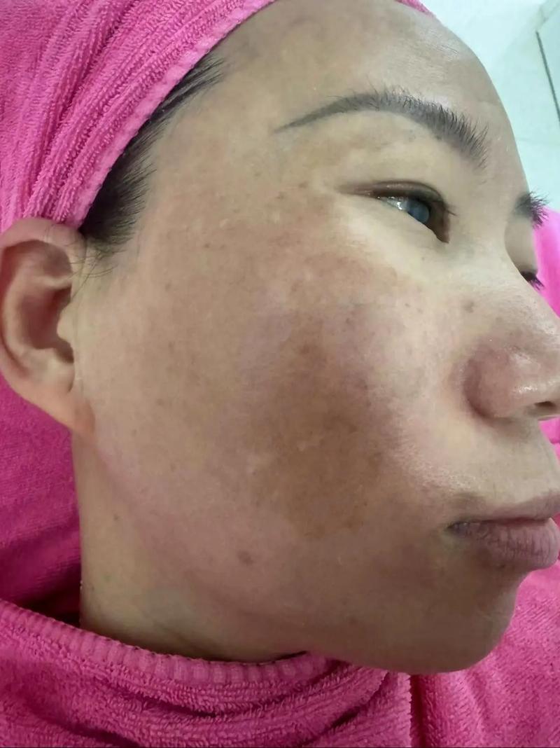 色斑长什么样