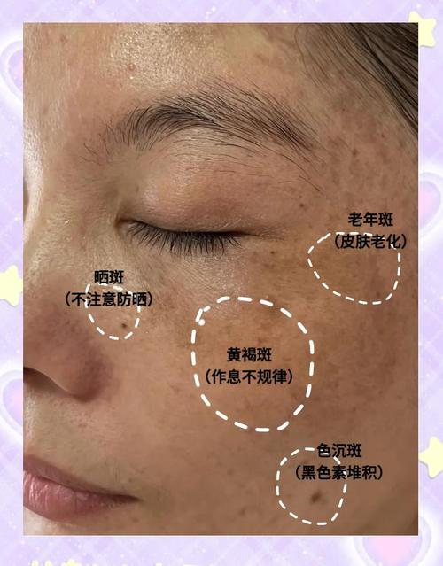 色斑长什么样