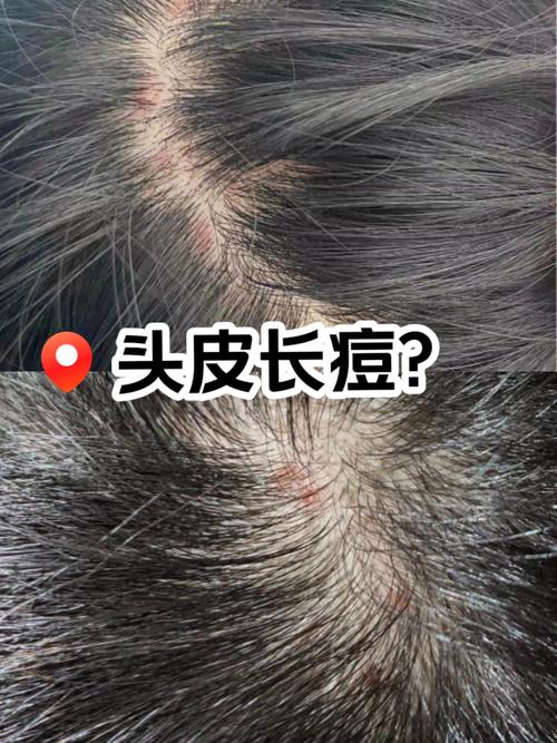 头上痘痘是什么原因