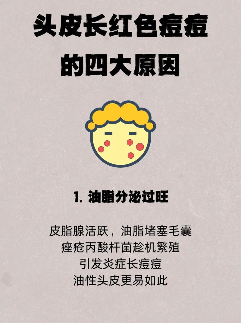 为什么头皮会长痘痘