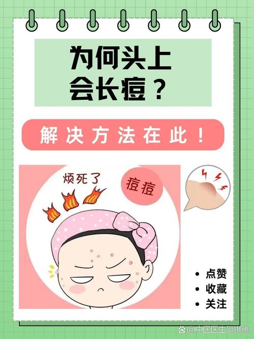 为什么头皮会长痘痘