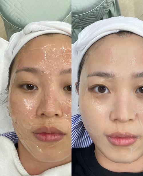 光子嫩肤有什么效果
